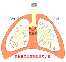 気管支喘息の症状